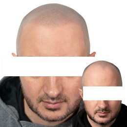 Client de Nat Lambert Tricopigmentation