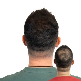 Client de Nat Lambert Tricopigmentation