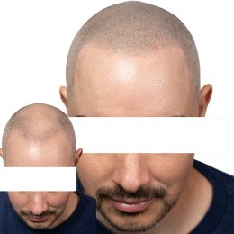 Client de Nat Lambert Tricopigmentation