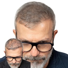 Client de Nat Lambert Tricopigmentation