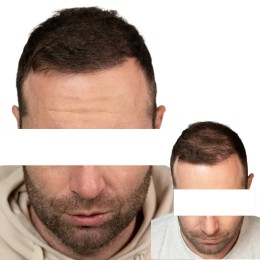 Client de Nat Lambert Tricopigmentation