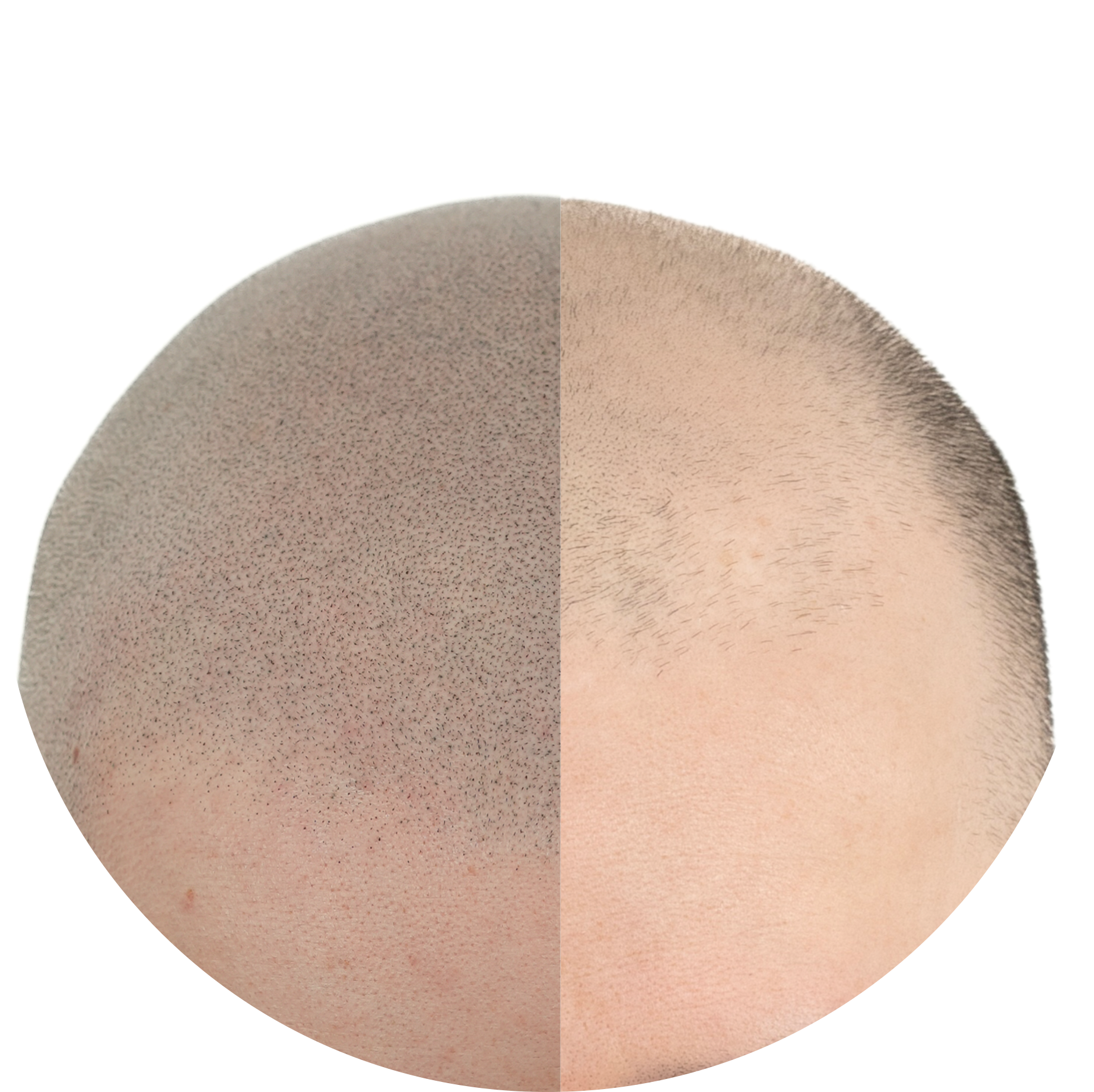 Nat Lambert Tricopigmentation