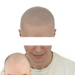 Client de Nat Lambert Tricopigmentation