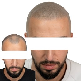 Client de Nat Lambert Tricopigmentation