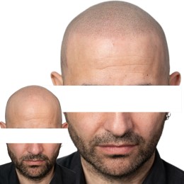 Client de Nat Lambert Tricopigmentation