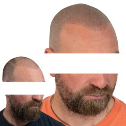 Client de Nat Lambert Tricopigmentation