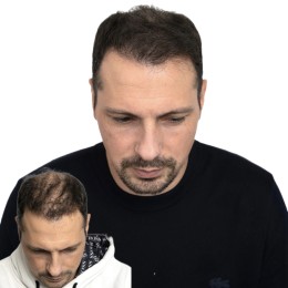 Client de Nat Lambert Tricopigmentation