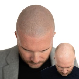 Client de Nat Lambert Tricopigmentation