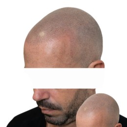 Client de Nat Lambert Tricopigmentation