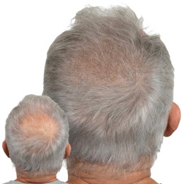 Client de Nat Lambert Tricopigmentation