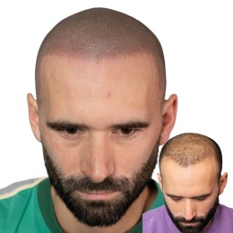 Client de Nat Lambert Tricopigmentation