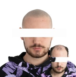 Client de Nat Lambert Tricopigmentation