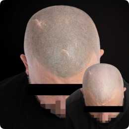 Client de Nat Lambert Tricopigmentation