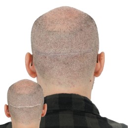 Client de Nat Lambert Tricopigmentation