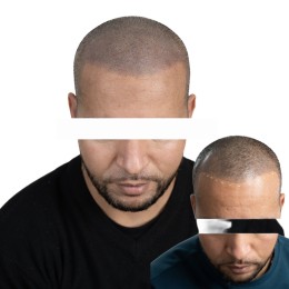 Client de Nat Lambert Tricopigmentation