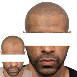 Client de Nat Lambert Tricopigmentation