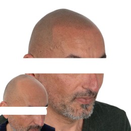 Client de Nat Lambert Tricopigmentation