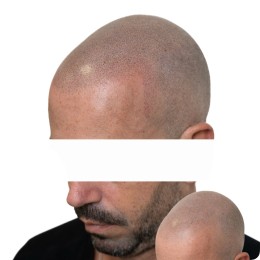 Client de Nat Lambert Tricopigmentation