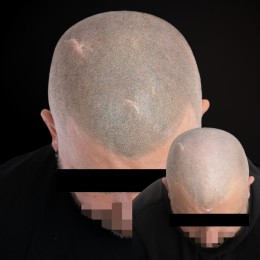 Client de Nat Lambert Tricopigmentation