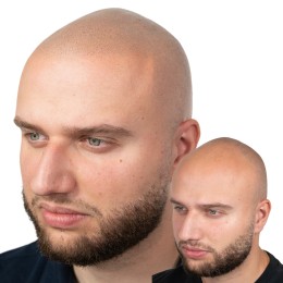 Client de Nat Lambert Tricopigmentation