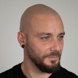 Client de Nat Lambert Tricopigmentation