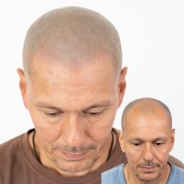 Client de Nat Lambert Tricopigmentation