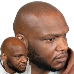 Client de Nat Lambert Tricopigmentation