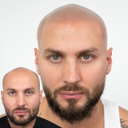 Client de Nat Lambert Tricopigmentation