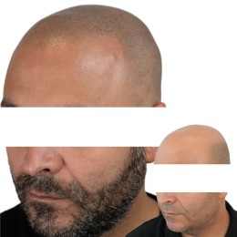 Client de Nat Lambert Tricopigmentation