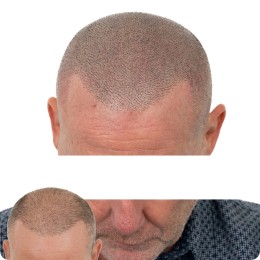 Client de Nat Lambert Tricopigmentation