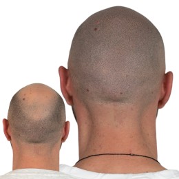 Client de Nat Lambert Tricopigmentation