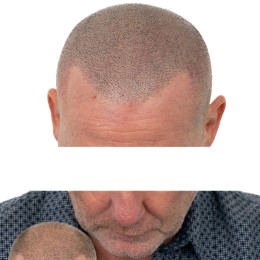 Client de Nat Lambert Tricopigmentation