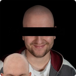 Client de Nat Lambert Tricopigmentation