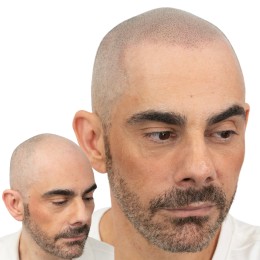 Client de Nat Lambert Tricopigmentation