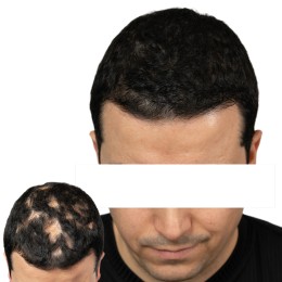 Client de Nat Lambert Tricopigmentation