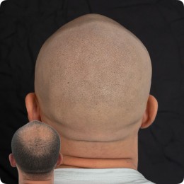 Client de Nat Lambert Tricopigmentation