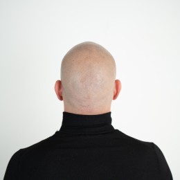 Client de Nat Lambert Tricopigmentation