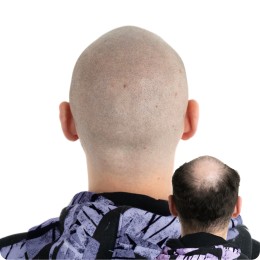 Client de Nat Lambert Tricopigmentation