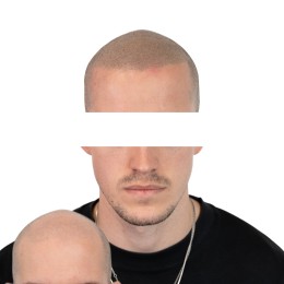 Client de Nat Lambert Tricopigmentation