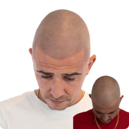 Client de Nat Lambert Tricopigmentation