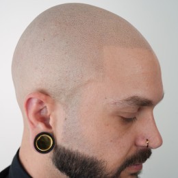 Client de Nat Lambert Tricopigmentation