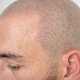 Client de Nat Lambert Tricopigmentation