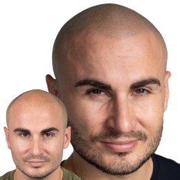 Client de Nat Lambert Tricopigmentation