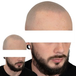 Client de Nat Lambert Tricopigmentation