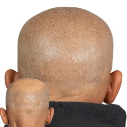 Client de Nat Lambert Tricopigmentation