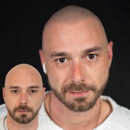 Client de Nat Lambert Tricopigmentation