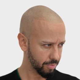 Client de Nat Lambert Tricopigmentation