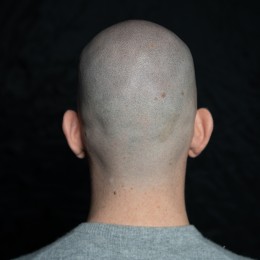 Client de Nat Lambert Tricopigmentation