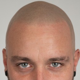 Client de Nat Lambert Tricopigmentation