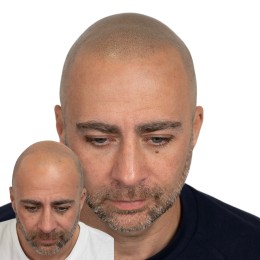 Client de Nat Lambert Tricopigmentation